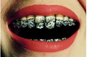 Smoking and Dental Implants do not mix