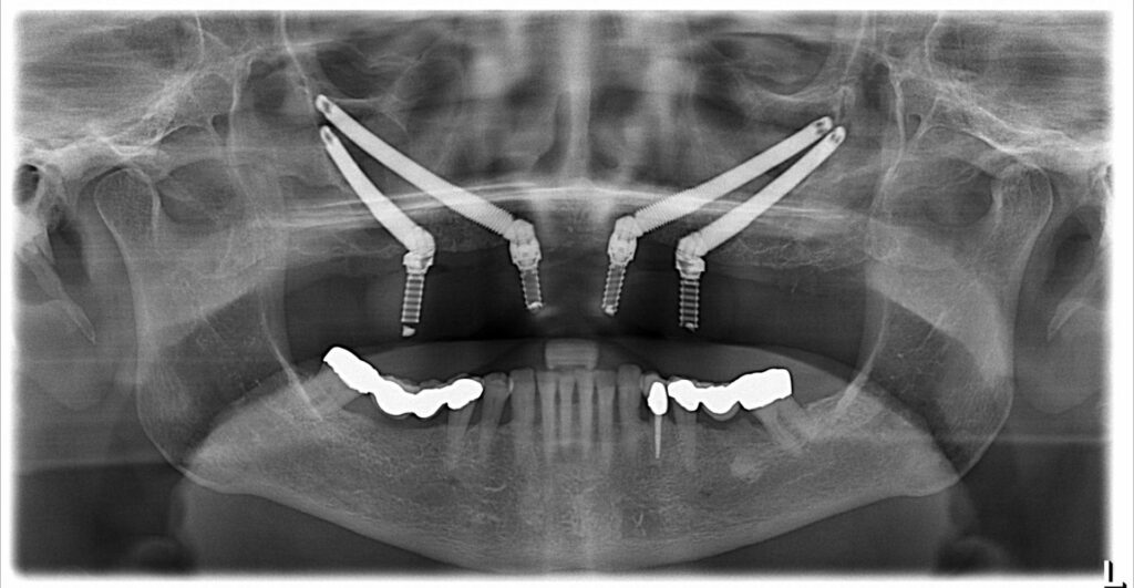 Zygomatic dental implants are beneficial for patients with severe bone loss