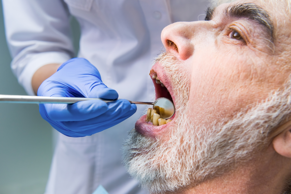 Reasons Why Teeth Go Bad- Teeth Implants