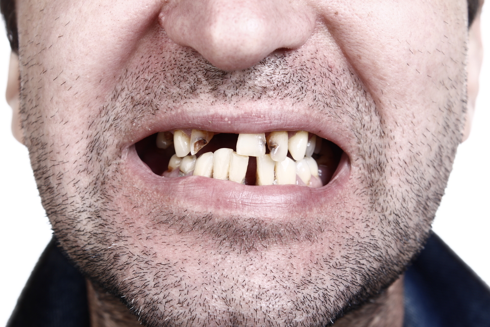 Poor Oral Care Leads to Teeth Implants
