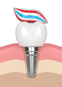 Cleaning Dental Implants