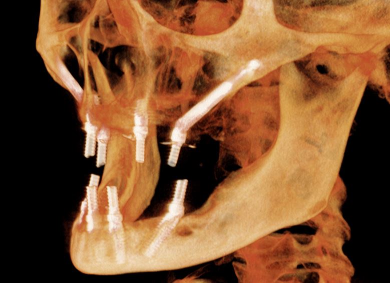 Zygomatic Implants