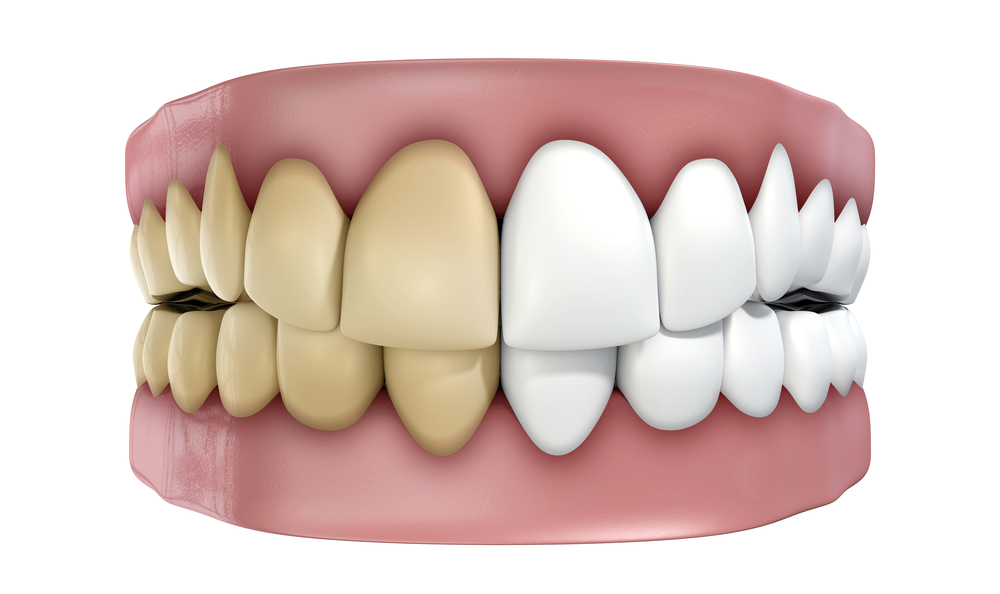 Foods That Stain Teeth Implants