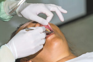 Tooth Extraction