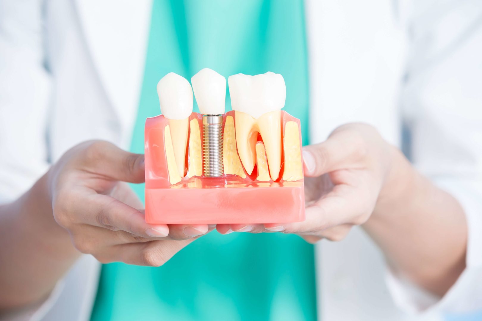Are Dental Implants Permanent How Long Do Dental Implants Last?