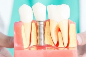 The History of Dental Implants