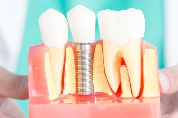 The History of Dental Implants