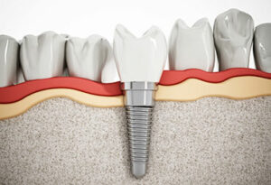 Dental Implants for One Tooth