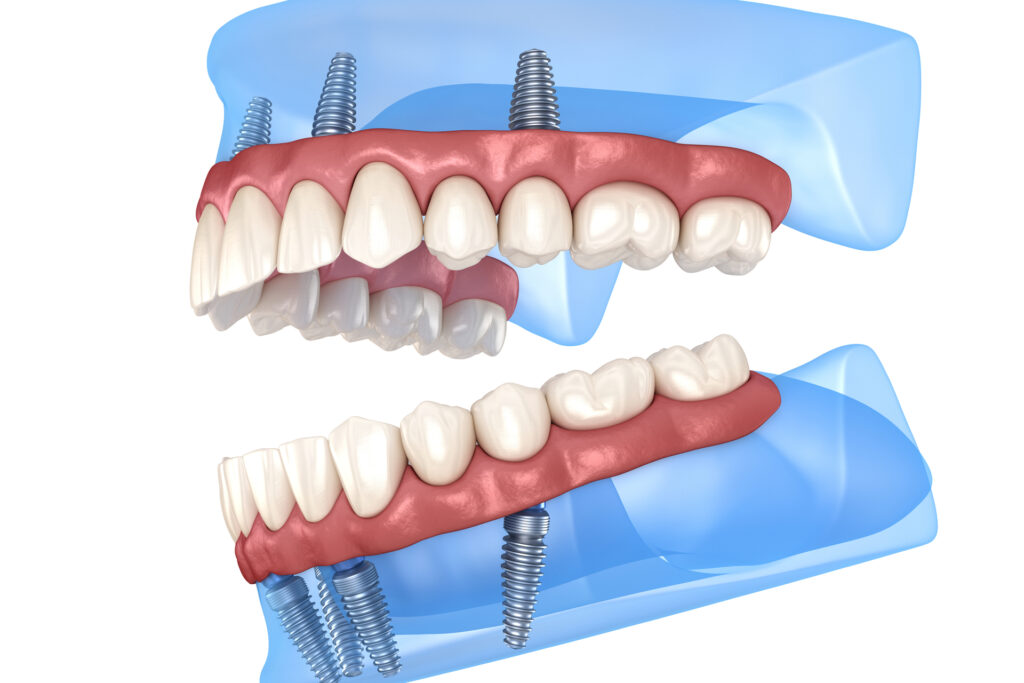 Maxillary and Mandibular prosthesis with gum All on 4 system supported by implants.