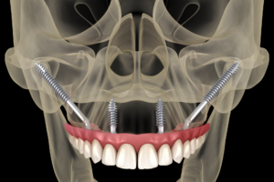 Zygomatic Implants