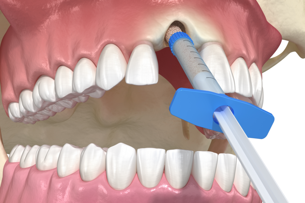 Benefits of Bone Grafting for Oral Care