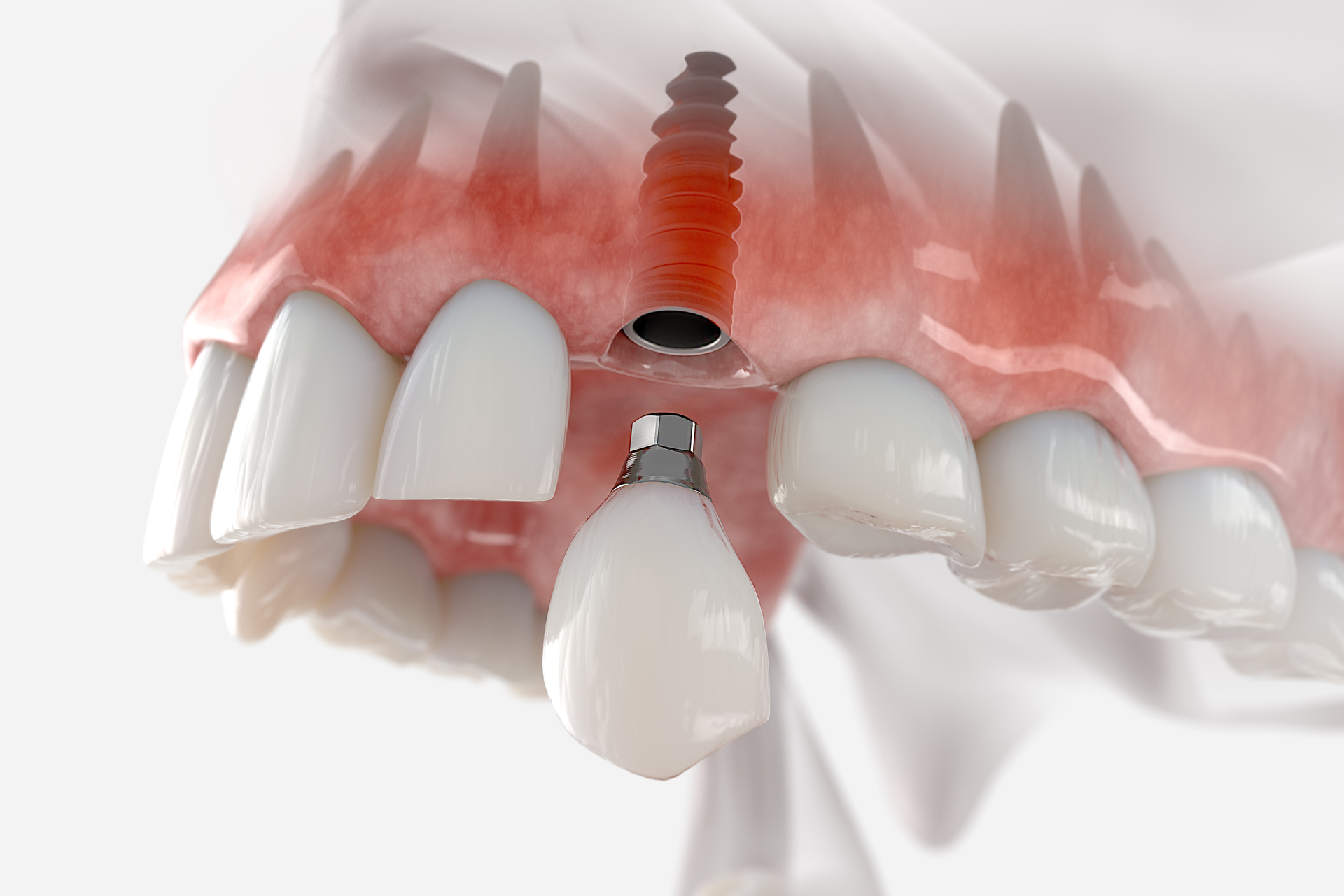 Common Questions About Zirconia Dental Implants FastNewSmile® Dental Implant Centers