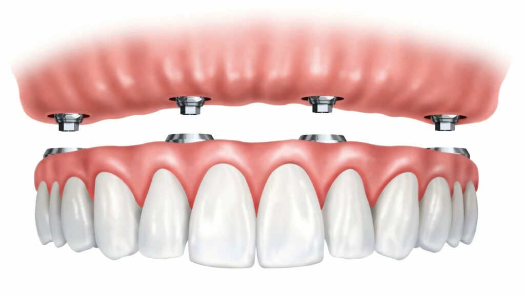 full-arch-dental-implants