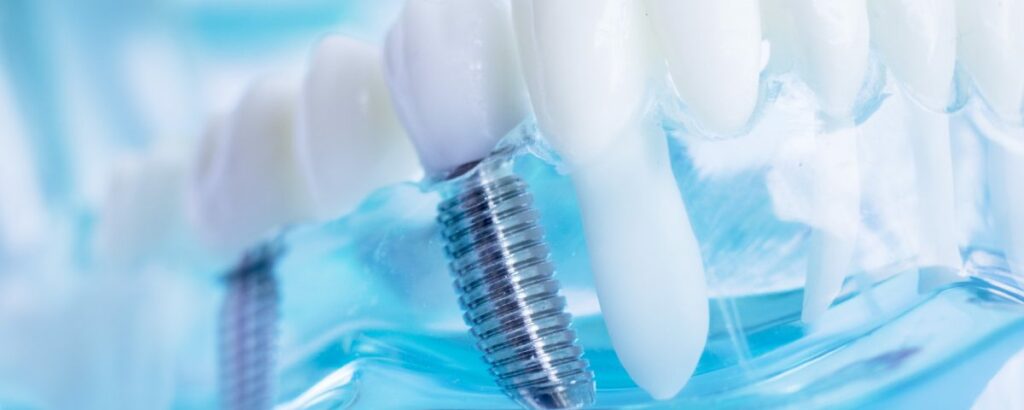 Brushing-dental-implants in Dallas