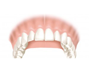 Custom Dentures