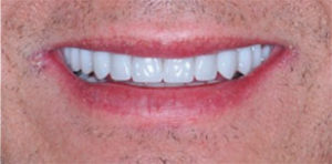 Andrews After Teeth