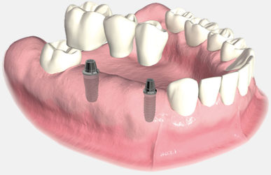 Bridge Implants