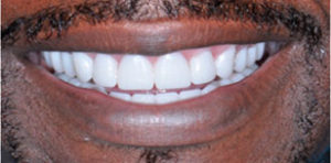 Darrell After Teeth