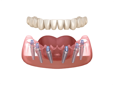 FastNewSmile’s All-on-Six Dental Implants