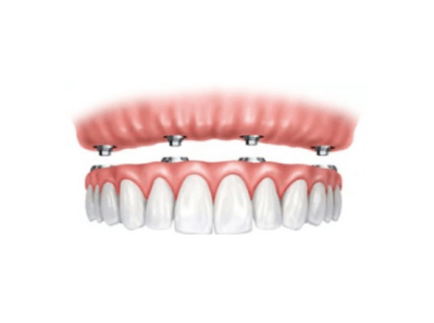 All-On-4® Dental Implants