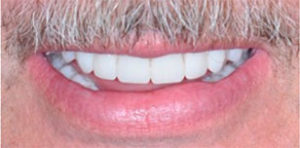 Garth After Teeth