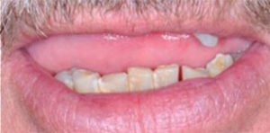Dental Implant Patient in Dallas Before Teeth
