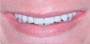 Teresa After Teeth