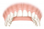 Teeth Dentures