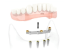 Teeth Implant Dentures