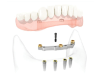 Teeth Implant Dentures in Dallas
