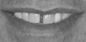 Dental Implant Patient in Dallas Before