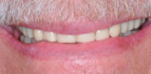 Dental Implant Patient in Dallas Before