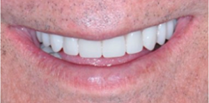Dental Implant Patient in Dallas After