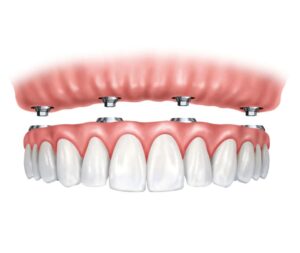 Dental Implants in Dallas All On 4