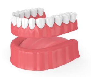 Dallas Dental Implant Dentures