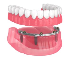 Dallas Dental Implant Dentures