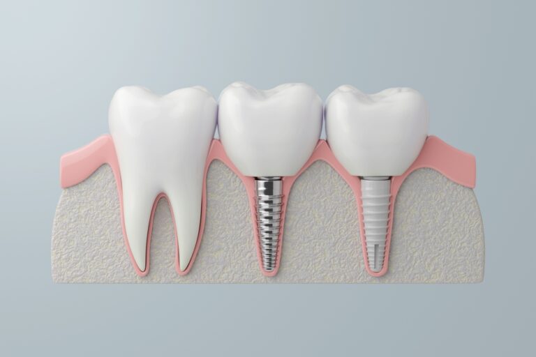 Titanium and Zirconia Implant Comparison