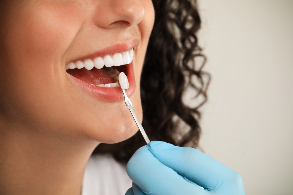 Zirconia Veneers Dallas