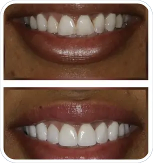 Veneers, before/after
